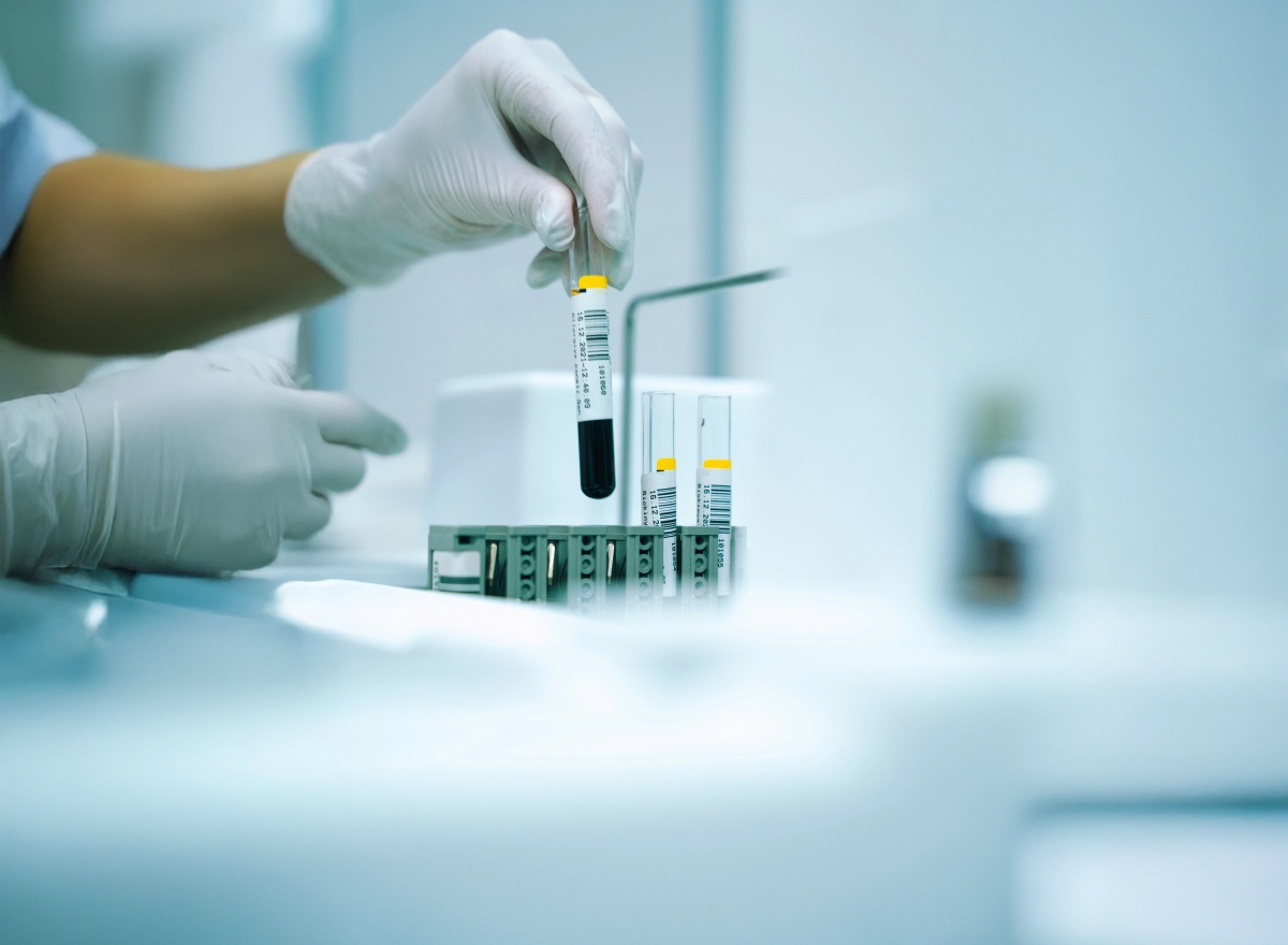 NIFTY teszt: a legpontosabb Down-szindróma szűrés terhesség alatt